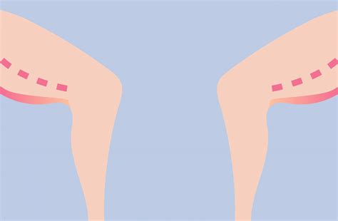 thight job|The Different Types Of Thigh Lift Procedures Compared.